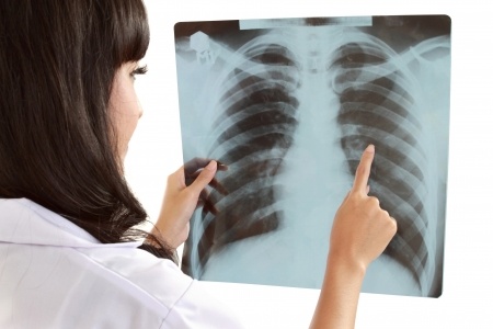 Röntgenfoto van longen
